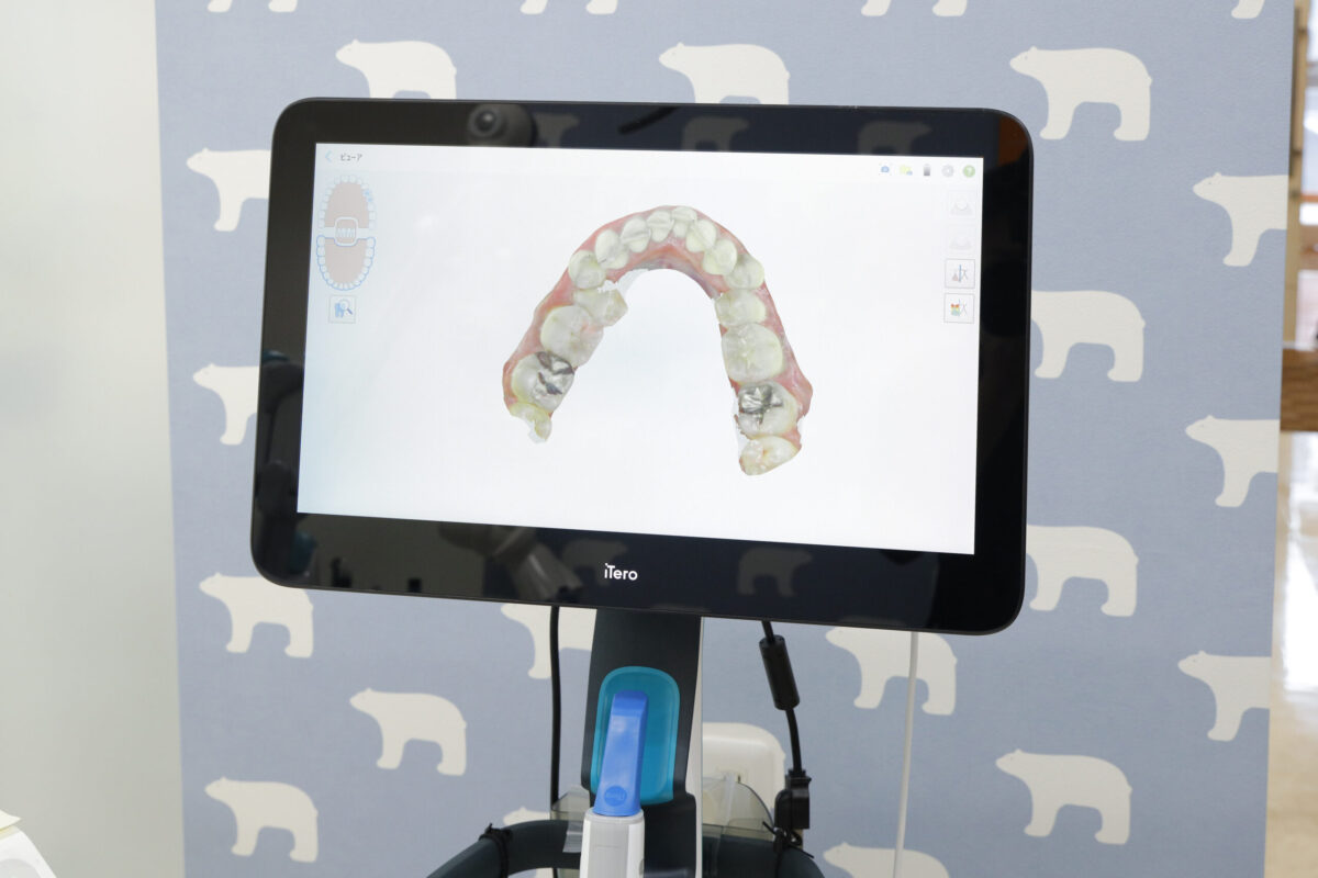 口腔内スキャナー:iTero(アイテロ)