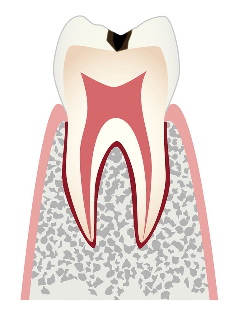むし歯C1のイラスト